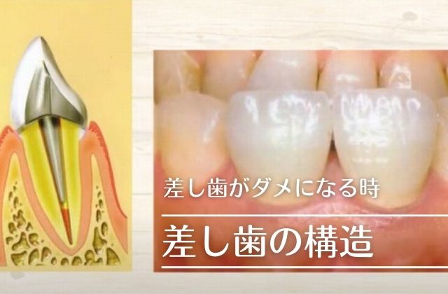 差し歯の土台が折れた割れた時の治療法｜高松市の歯を抜かない治療なら吉本歯科医院